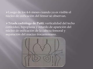 Luego de los 4-6 meses cuando ya es visible el
núcleo de osificación del fémur se observan.

Tríada radióloga de Putti: verticalidad del techo
cotiloideo, hipoplasia y retardo de aparición del
núcleo de osificación de la cabeza femoral y
separación del macizo trocantereano.
 