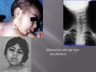 Alteración del eje tipo
   escoliotico
 