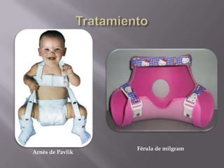 Férula de milgram
Arnés de Pavlik
 