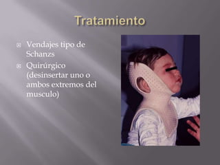    Vendajes tipo de
    Schanzs
   Quirúrgico
    (desinsertar uno o
    ambos extremos del
    musculo)
 