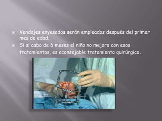    Vendajes enyesados serán empleados después del primer
    mes de edad.
   Si al cabo de 6 meses el niño no mejoro con esos
    tratamientos, es aconsejable tratamiento quirúrgico.
 