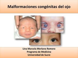 Malformaciones congénitas del ojo

Lina Marcela Merlano Romero
Programa de Medicina
Universidad de Sucre

 