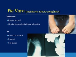 Pie Varo (metatarso aducto congénito)
Exámenes
Retopie normal
Metatarsianos desviados en aducción
Tx
Yesos correctores
Semanal
3-6 meses
 