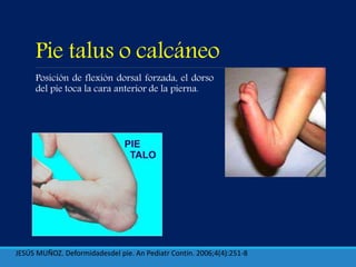 Pie talus o calcáneo
Posición de flexión dorsal forzada, el dorso
del pie toca la cara anterior de la pierna.
JESÚS MUÑOZ. Deformidadesdel pie. An Pediatr Contin. 2006;4(4):251-8
 