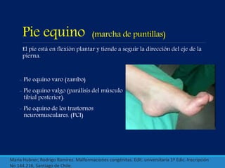 Pie equino (marcha de puntillas)
El pie está en flexión plantar y tiende a seguir la dirección del eje de la
pierna.
María Hubner, Rodrigo Ramírez. Malformaciones congénitas. Edit. universitaria 1ª Edic. Inscripción
No 144.216, Santiago de Chile.
- Pie equino varo (zambo)
- Pie equino valgo (parálisis del músculo
tibial posterior).
- Pie equino de los trastornos
neuromusculares. (PCI)
 