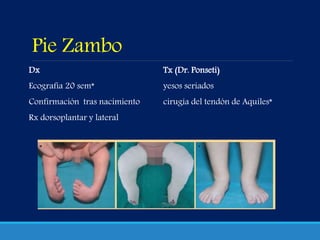 Pie Zambo
Dx
Ecografía 20 sem*
Confirmación tras nacimiento
Rx dorsoplantar y lateral
Tx (Dr. Ponseti)
yesos seriados
cirugía del tendón de Aquiles*
 