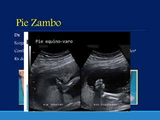 Pie Zambo
Dx
Ecografía 20 sem*
Confirmación tras nacimiento
Rx dorsoplantar y lateral
Tx (Dr. Ponseti)
yesos seriados
cirugía del tendón de Aquiles*
 