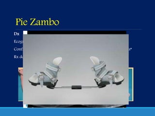 Pie Zambo
Dx
Ecografía 20 sem*
Confirmación tras nacimiento
Rx dorsoplantar y lateral
Tx (Dr. Ponseti)
yesos seriados
cirugía del tendón de Aquiles*
 