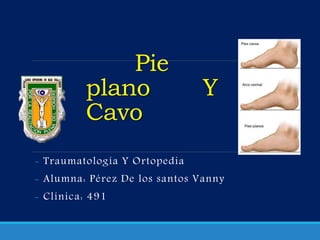 Pie
plano Y
Cavo
- Traumatología Y Ortopedia
- Alumna: Pérez De los santos Vanny
- Clínica: 491
 