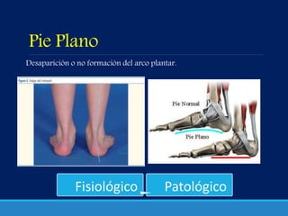 Pie Plano
Desaparición o no formación del arco plantar.
Fisiológico Patológico
 