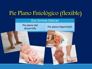 Pie Plano Fisiológico (flexible)
Dos formas básicas
Pie plano hipermóvil
Pie plano del
desarrollo
 