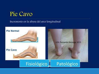 Pie Cavo
Incremento en la altura del arco longitudinal
Fisiológico Patológico
 