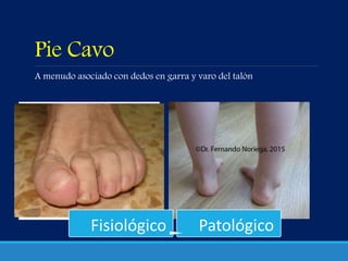Pie Cavo
A menudo asociado con dedos en garra y varo del talón
Fisiológico Patológico
 