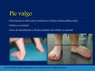 Pie valgo
Desviación en dirección contraria a la línea media (abducción)
Talón en eversión
Arco de dorsiflexión y flexión plantar del tobillo es normal
JESÚS MUÑOZ. Deformidadesdel pie. An Pediatr Contin. 2006;4(4):251-8
 