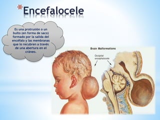*Encefalocele
Es una protrusión o un
bulto (en forma de saco)
formado por la salida del
encéfalo y las membranas
que lo recubren a través
de una abertura en el
cráneo.
 