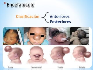 Clasificación Anteriores
Posteriores
*Encefalocele
 
