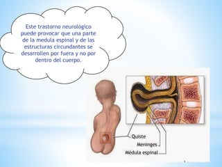 Este trastorno neurológico
puede provocar que una parte
de la medula espinal y de las
estructuras circundantes se
desarrollen por fuera y no por
dentro del cuerpo.
 