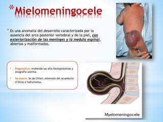 *Mielomeningocele
* Es una anomalía del desarrollo caracterizada por la
ausencia del arco posterior vertebral y de la piel, con
exteriorización de las meninges y la medula espinal,
abiertas y malformadas.
• Diagnostico: midiendo las alfa-fectoptoteinas y
ecografía uterina.
• Se asocia: Sx de Chiari, estenosis del acueducto
d Silvio e hidromielia.
 