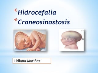 *Hidrocefalia
*Craneosinostosis
Lidiana Mariñez
 
