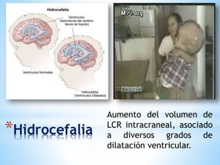 *Hidrocefalia
Aumento del volumen de
LCR intracraneal, asociado
a diversos grados de
dilatación ventricular.
 