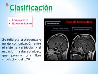 *Clasificación
Se refiere a la presencia o
no de comunicación entre
el sistema ventricular y el
espacio subaracnoideo,
que permite una libre
circulación del LCR.
• Comunicante
• No comunicante
 