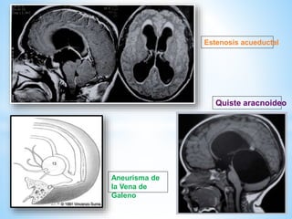 * .
Estenosis acueductal
Aneurisma de
la Vena de
Galeno
Quiste aracnoideo
 