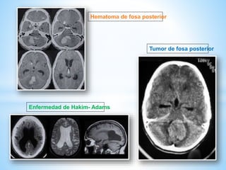 .
Hematoma de fosa posterior
Tumor de fosa posterior
Enfermedad de Hakim- Adams
 