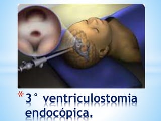 *3° ventriculostomia
endocópica.
.
 