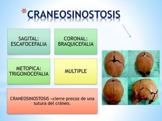 SAGITAL:
ESCAFOCEFALIA
CORONAL:
BRAQUICEFALIA
METOPICA:
TRIGONOCEFALIA
MULTIPLE
CRANEOSINOSTOSIS «cierre precoz de una
sutura del cráneo.
*CRANEOSINOSTOSIS
 
