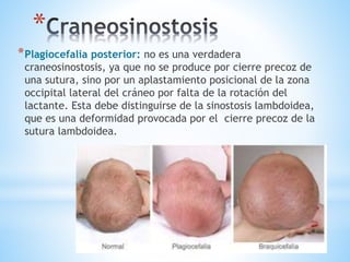 *
*Plagiocefalia posterior: no es una verdadera
craneosinostosis, ya que no se produce por cierre precoz de
una sutura, sino por un aplastamiento posicional de la zona
occipital lateral del cráneo por falta de la rotación del
lactante. Esta debe distinguirse de la sinostosis lambdoidea,
que es una deformidad provocada por el cierre precoz de la
sutura lambdoidea.
 