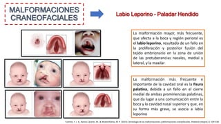 MALFORMACIONES
CRANEOFACIALES
Labio Leporino – Paladar Hendido
La malformación más frecuente e
importante de la cavidad oral es la fisura
palatina, debida a un fallo en el cierre
medial de ambas prominencias palatinas,
que da lugar a una comunicación entre la
boca y la cavidad nasal superior y que, en
su forma más grave, se asocia a labio
leporino
La malformación mayor, más frecuente,
que afecta a la boca y región perioral es
el labio leporino, resultado de un fallo en
la proliferación y posterior fusión del
tejido embrionario en la zona de unión
de las protuberancias nasales, medial y
lateral, y la maxilar
Fuentes, F. J. R., Ramos Cáceres, M., & Ribate Molina, M. P. (2014). Semiología de las malformaciones y deformaciones craneofaciales. Pediatría Integral, 8, 529–538.
 