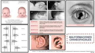 MALFORMACIONES
CRANEOFACIALES
Fuentes, F. J. R., Ramos Cáceres, M., & Ribate Molina, M. P. (2014). Semiología de las malformaciones y deformaciones craneofaciales. Pediatría Integral, 8,
529–538.
 