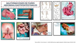 MALFORMACIONES DE PARED
ABDOMINAL/GASTROINTESTINALES
Barrena Delfa, S., & Luis Huertas, A. L. (2019). Malformaciones congénitas digestivas. Pediatria Integral, 23(6), 301–309.
 