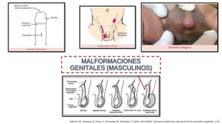 MALFORMACIONES
GENITALES (MASCULINOS)
Bidondo, M., Groisman, B., Flores, R., Ormazabal, M., & Barbero, P. (2015). Atlas RENAC. Guía para la detección y descripción de las anomalías congénitas. 1–53.
 