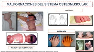 MALFORMACIONES DEL SISTEMA OSTEOMUSCULAR
Amelia/Focomelia/Tetramelia
Manouvrier-Hanu, S., & Mezel, A. (2011). Clasificación de las malformaciones congénitas de los miembros. EMC - Aparato Locomotor, 44(1), 1–6.
Polidactalia
Sindactalia
 