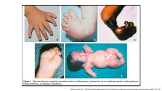 Martínez-Frías, M. L. (2010). Características generales de los defectos congénitos, terminología y causas. Semergen, 36(3), 135–139.
 