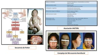 Secuencia de Potter
Asociación VACTERL
Complejo de Microsomía Hemifacial
 