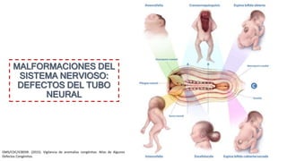 MALFORMACIONES DEL
SISTEMA NERVIOSO:
DEFECTOS DEL TUBO
NEURAL
OMS/CDC/ICBDSR. (2015). Vigilancia de anomalías congénitas: Atlas de Algunos
Defectos Congénitos.
 