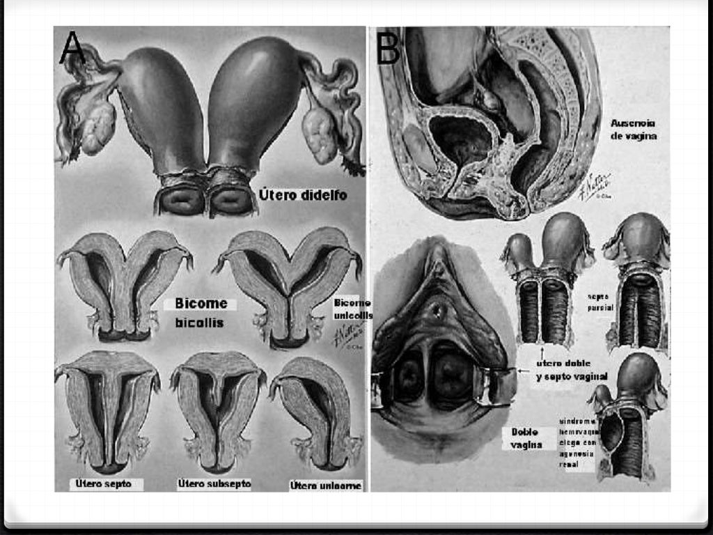 Malformaciones del aparato genital femenino