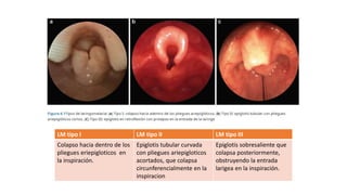 LM leve LM moderada LM grave
80-90% casos Regurgitación, vómitos
recurrentes, tos ocasional,
asfixia
Regurgitación, vómitos
recurrentes, tos ocasional,
asfixia
LM tipo I LM tipo II LM tipo III
Colapso hacia dentro de los
pliegues eriepigloticos en
la inspiración.
Epiglotis tubular curvada
con pliegues ariepigloticos
acortados, que colapsa
circunferencialmente en la
inspiracion
Epiglotis sobresaliente que
colapsa posteriormente,
obstruyendo la entrada
larigea en la inspiración.
 