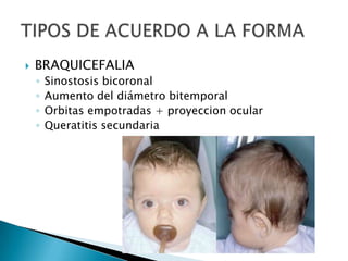  BRAQUICEFALIA
◦ Sinostosis bicoronal
◦ Aumento del diámetro bitemporal
◦ Orbitas empotradas + proyeccion ocular
◦ Queratitis secundaria
 