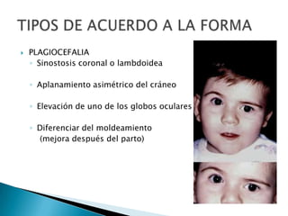  PLAGIOCEFALIA
◦ Sinostosis coronal o lambdoidea
◦ Aplanamiento asimétrico del cráneo
◦ Elevación de uno de los globos oculares
◦ Diferenciar del moldeamiento
(mejora después del parto)
 