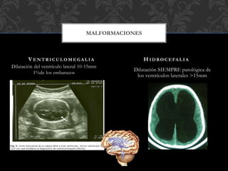 Dilatación del ventrículo lateral 10-15mm
1%de los embarazos
Dilatación SIEMPRE patológica de
los ventrículos laterales >15mm
V E N T R I C U L O M E G A L I A H I D R O C E FA L I A
MALFORMACIONES
 
