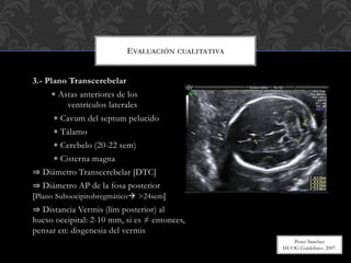 3.- Plano Transcerebelar
 Astas anteriores de los
ventrículos laterales
 Cavum del septum pelucido
 Tálamo
 Cerebelo (20-22 sem)
 Cisterna magna
⇒ Diámetro Transcerebelar [DTC]
⇒ Diámetro AP de la fosa posterior
[Plano Suboocipitobregmático >24sem]
⇒ Distancia Vermis (lím posterior) al
hueso occipital: 2-10 mm, si es ≠ entonces,
pensar en: disgenesia del vermis
EVALUACIÓN CUALITATIVA
Perez Sánchez
ISUOG Guidelines. 2007.
 