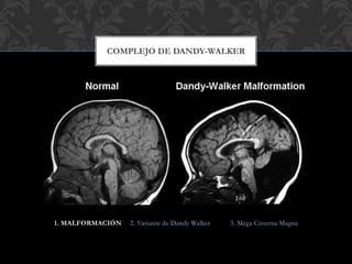 1. MALFORMACIÓN 2. Variante de Dandy Walker 3. Mega Cisterna Magna
COMPLEJO DE DANDY-WALKER
 
