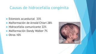 Causas de hidrocefalia congénita
 Estenosis acueductal 33%
 Malformación de Arnold Chiari 28%
 Hidrocefalia comunicante 22%
 Malformación Dandy Walker 7%
 Otros 10%
 