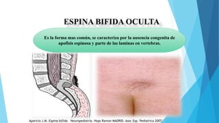 ESPINA BIFIDA OCULTA
Es la forma mas común, se caracteriza por la ausencia congenita de
apofisis espinosa y parte de las laminas en vertebras.
Aparicio J.M. Espina bifida. Neuropediatría. Hops Ramon MADRID. Asoc Esp. Pediatrica 2007.
 