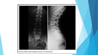 Cuadro clínico
Meningocele
Asintomático
Masa sobre columna vertebral
Constipación
Disfunción de vejiga
Fístula recto-vagin...