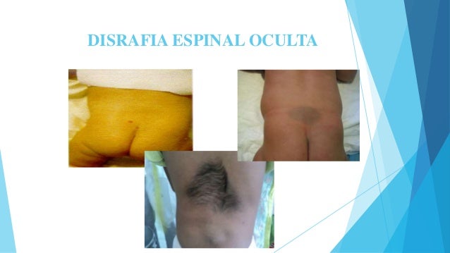 Los aceites de la psoriasis