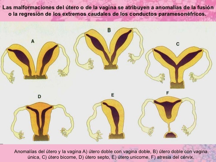 Malformaciones En El Sistema Reproductor Femenino